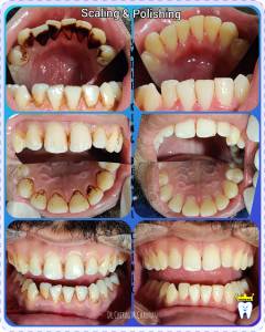 Scaling (teeth cleaning)