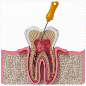 Root canal treatment