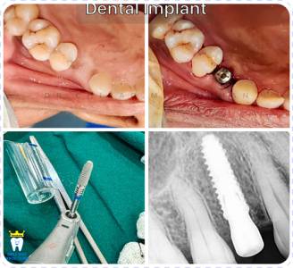 Dental implants