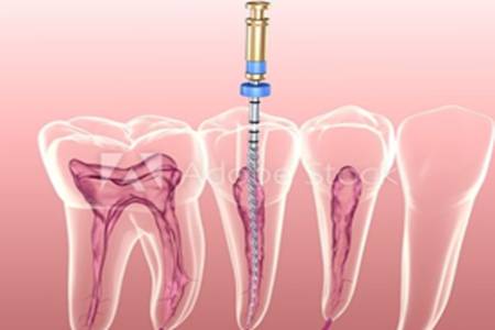 Root Canal Therapy