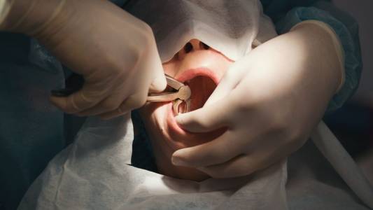 Tooth Extraction in Bharuch