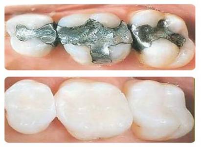 Tooth Coloured Fillings
