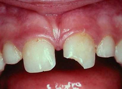 Dental Fracture Management