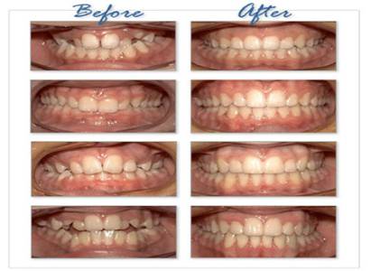 Orthodontic Teeth