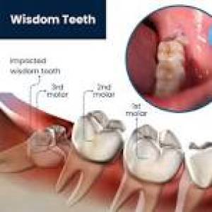 wisdom teeth