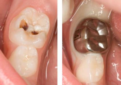 Dental Crowns
