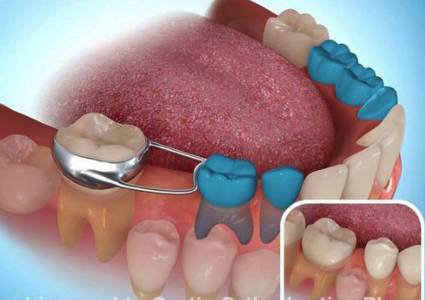 Root canal treatments