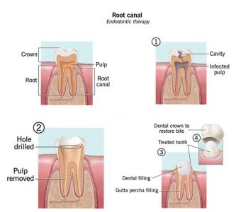 Root Canal Treatment in Pune