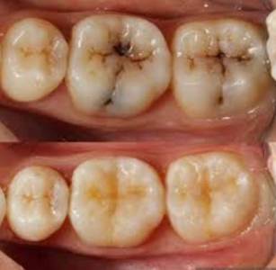 Tooth Restoration Treatment in Pune