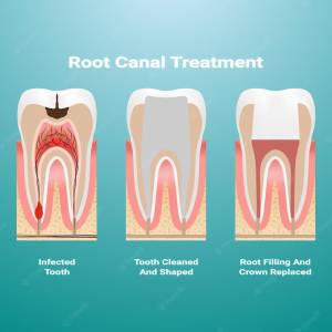 Root Canal Treatment
