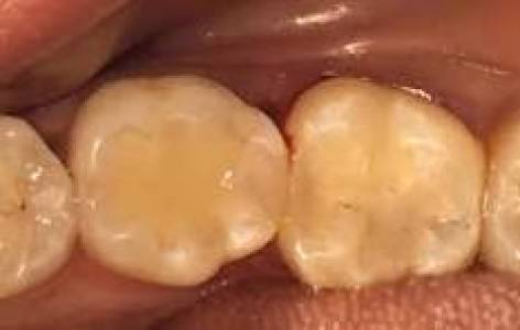 TOOTH COLORED FILLINGS