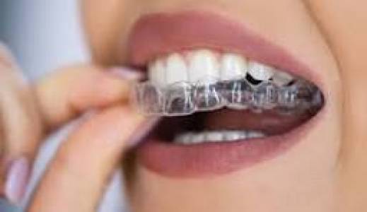ALIGNERS