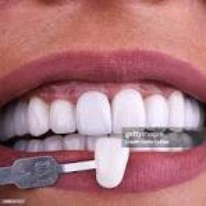 Composite White Fillings Pune