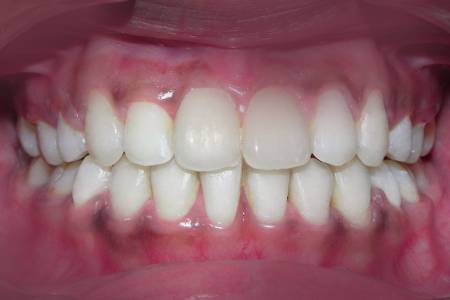 Root Cavity Fillings Pune