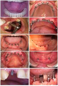 DENTAL IMPLANTS TREATMENT