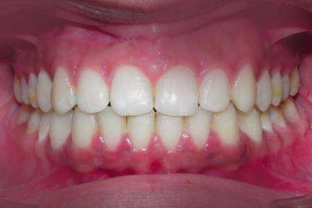 Dental Whitening