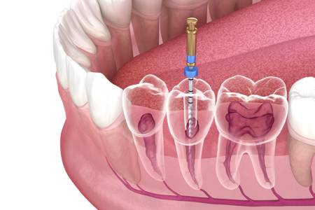 Root Canals