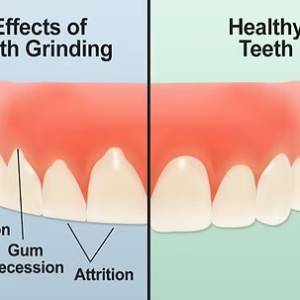 treatment of bruxism