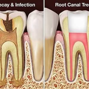 ROOT CANAL