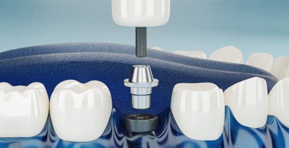Dental Implant