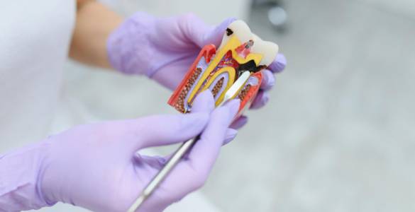 Root Canal Treatment