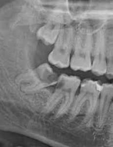 Wisdom tooth surgery in Pune