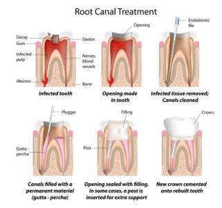 Root Canal