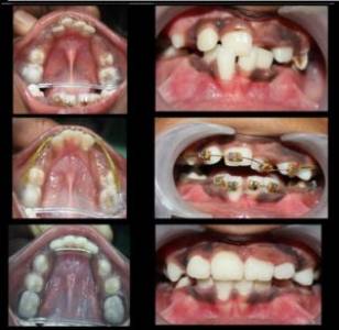 Best Orthodontist in Pune