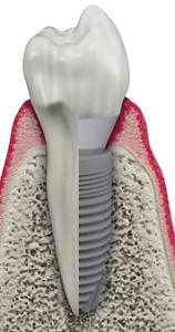 Dental Implants
