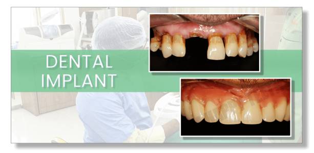 Dental Implant in Pimple Saudagar