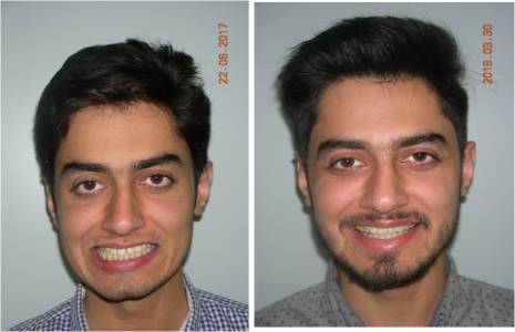 Invisalign Orthodontics