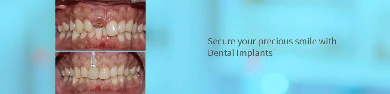Single & Multiple Teeth Dental Implants