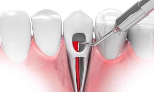 Root Canal Treatment