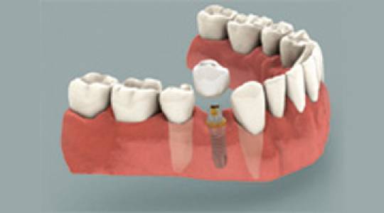 Implant with a crown