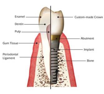 Single Tooth Replacement