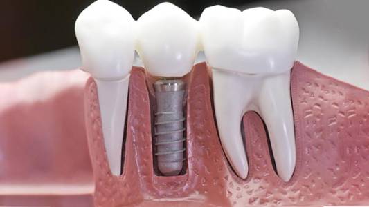 Implant Dentistry