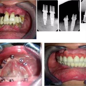 DENTAL IMPLANTS