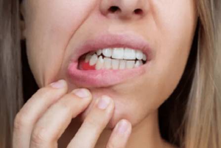 bleeding gums