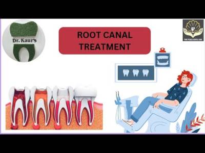 root canal