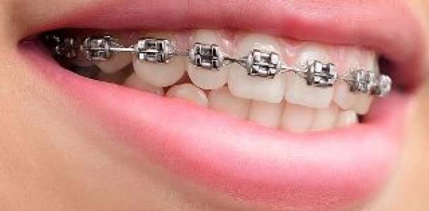 aligners