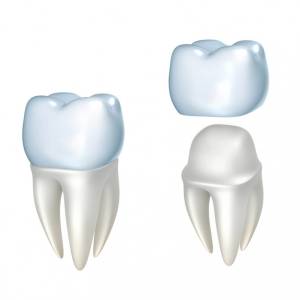 Dental Crowns