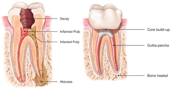 Root Canal Treatment