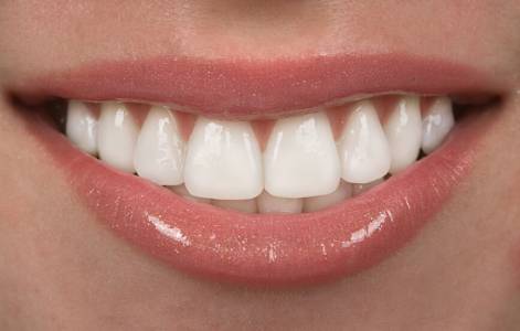 Veneers or Facing