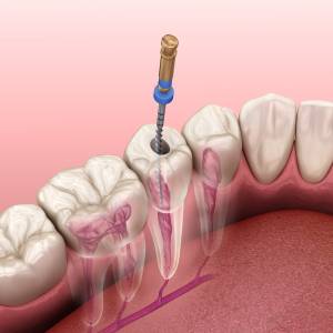 ROOT CANAL TREATMENT