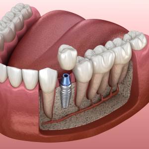 DENTAL IMPLANTS