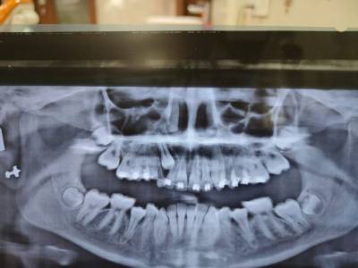 Single Sitting RCT, Crown and bridges