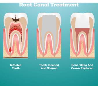 ROOT CANAL TREATMENT
