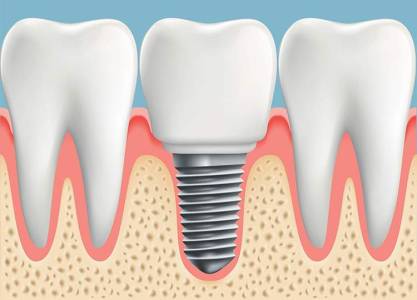 Dental Implants