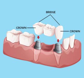 DENTAL CROWN AND BRIDGES