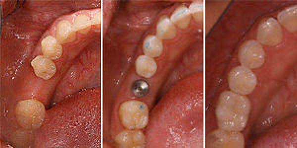Dental Implants Treatment